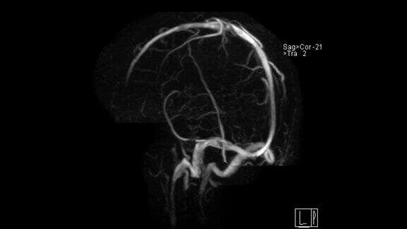 MRV脑或MR脑静脉造影