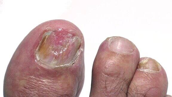 大脚趾指甲有甲真菌病