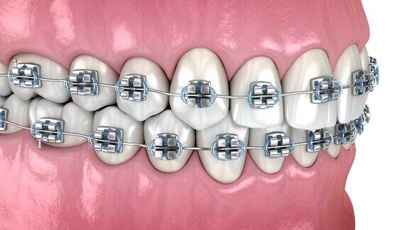 牙齿位置异常用金属支架矫正医学精确牙科3D动画