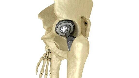 髋关节置换植入物安装在骨盆骨医学精准3D动画