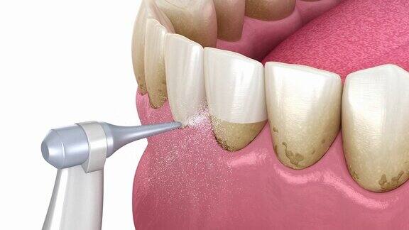 冲洗器水清洗牙齿医学上精确的口腔卫生3D动画