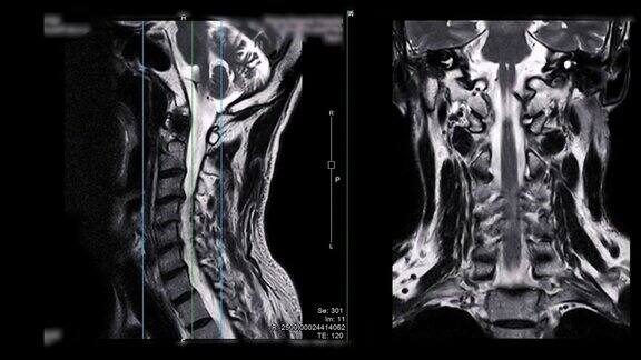 颈椎MRI比较矢状位T2W和冠状位T2W图诊断脊髓受压