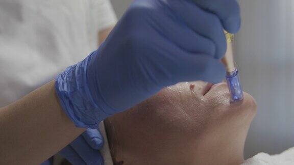 美容师在一个女人的脸上做针刺治疗特写