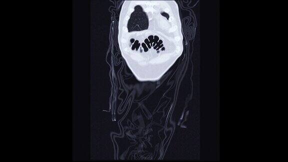 CT结肠镜冠状面