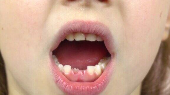这是一个小女孩的特写她的嘴露出了脱落的乳牙做着鬼脸