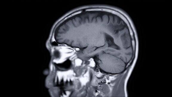 MRI为脑矢状位T1W平面脑磁共振成像