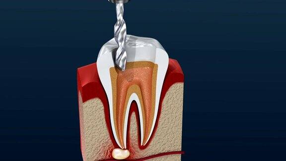 根管治疗过程3d动画