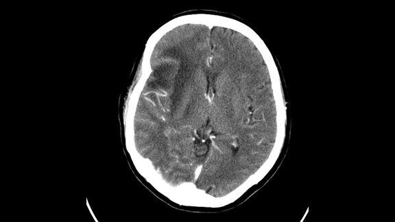 注射造影剂后CTA脑轴位MIP显像检查脑动脉瘤