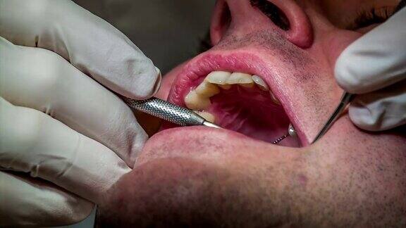 牙科医生开始在病人的上牙上钻孔