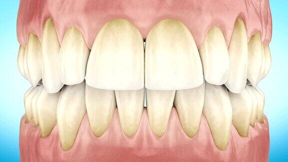 肮脏的黄色牙齿放大3d动画阿尔法通道