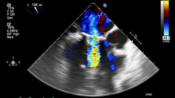 高品质影像超声经食管心脏检查