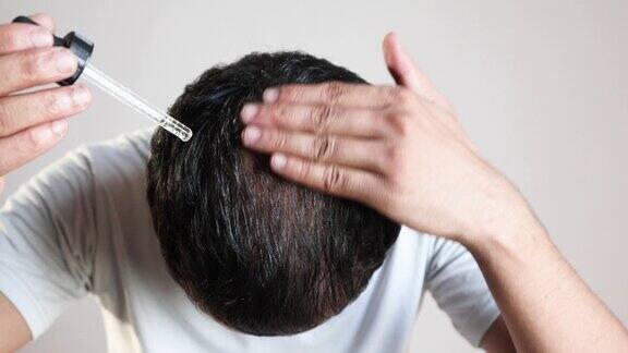 男士将脱发血清或米诺地尔应用于秃头头皮头发护理