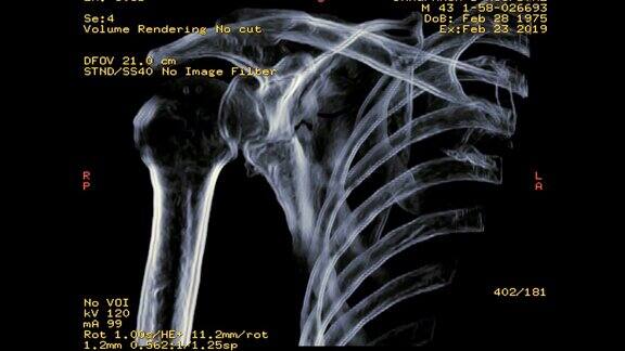 右肩CT显示骨折肩胛骨三维渲染图像