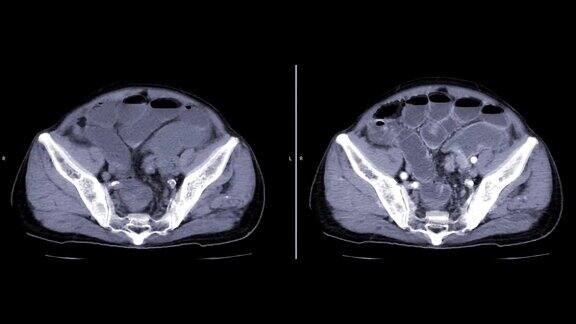 全腹非造影剂与造影剂显示肠梗阻的CT比较