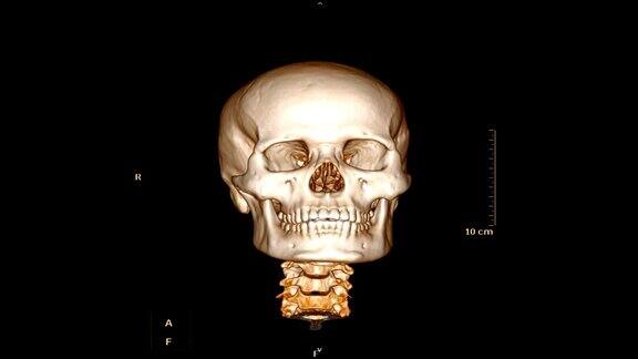 外伤患者颅骨面骨的CT扫描