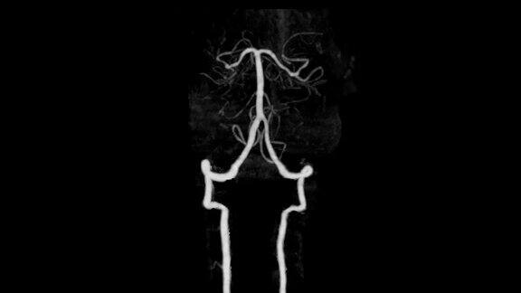 CTA脑部扫描或计算机断层血管造影3D渲染