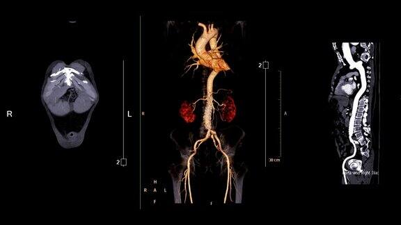 CTA腹主动脉对比冠状面、三维渲染图像和曲线MPR