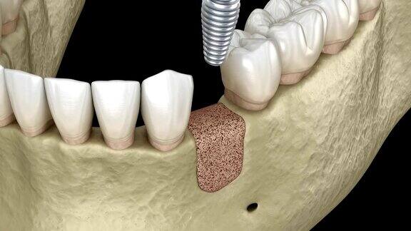增强手术-增加新骨和植入物三维动画
