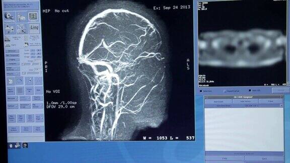 医生在电脑上检查核磁共振扫描