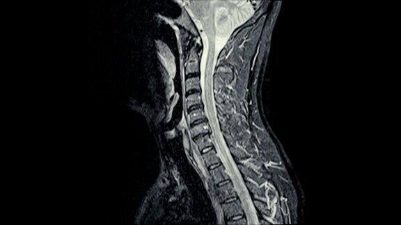 颈椎矢状面磁共振图像C5、C6、C7椎间盘损伤