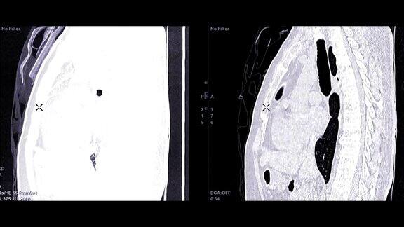 CTA胸部对比矢状MIP和矢状2D诊断肺栓塞(PE)和肺癌