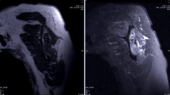 肩关节磁共振成像(MRI)