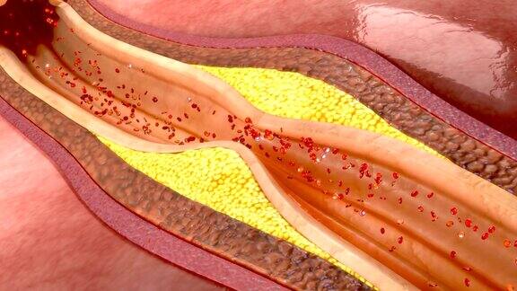 冠状动脉中的血凝块