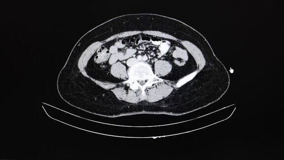卵巢肿瘤病人腹部之CT电影扫描