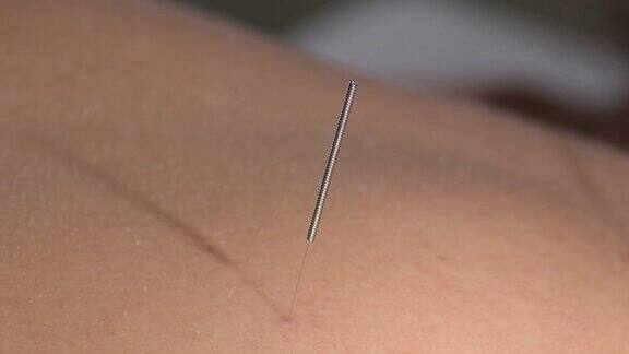 针灸针刺在女病人的背部