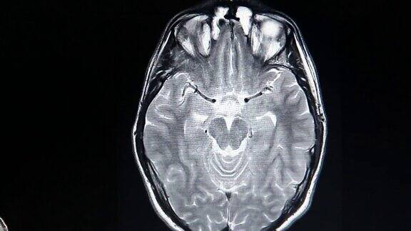 核磁共振大脑扫描