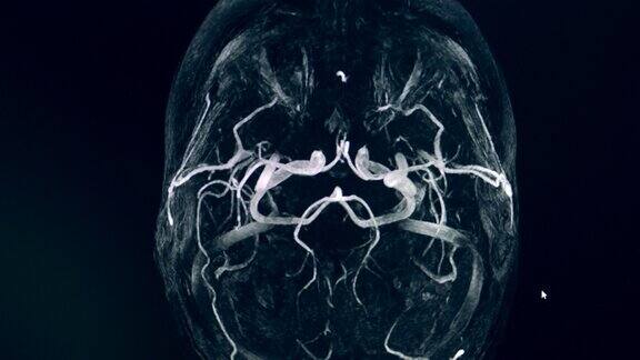 大脑动脉圈的动态CT图像