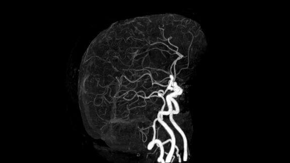 CTA脑或计算机断层血管造影的脑动脉MIP图像在屏幕上旋转