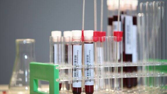 实验室检测血液样本中的冠状病毒-COVID-19检测