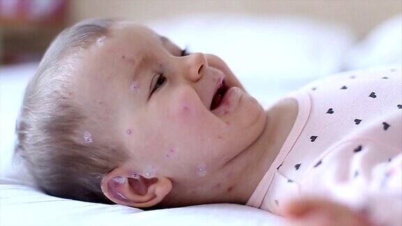 哭闹的小女孩得了麻疹