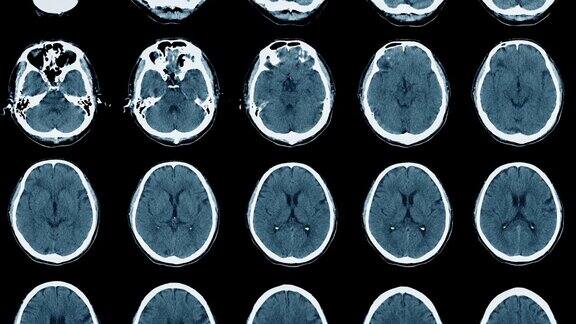 CT脑部图像与滑动