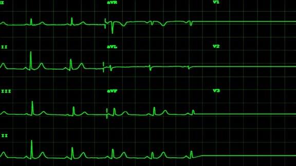 心电图显示有声音的心脏停止跳动