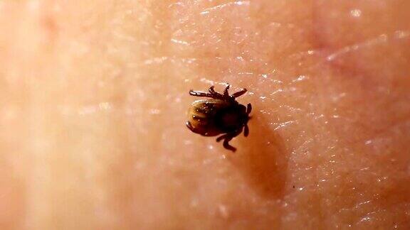 蜱虫附着在人类皮肤上以血液为食