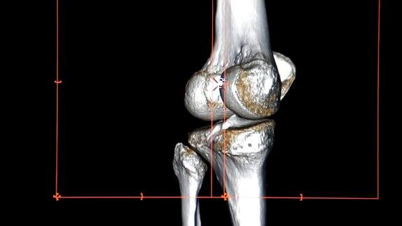 右膝计算机断层扫描(CT)图像3D渲染图像