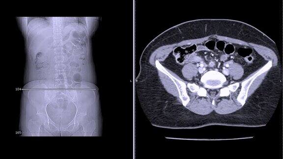 CT扫描CT全腹轴位造影剂扫描阑尾炎