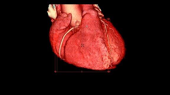 CTA冠脉三维渲染图像在屏幕上旋转用于冠脉狭窄的血管诊断