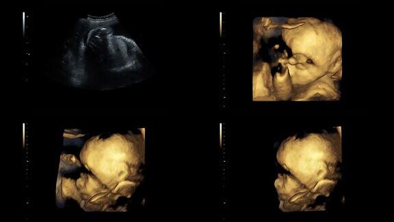 超音波显示25周时同卵双胞胎的心跳