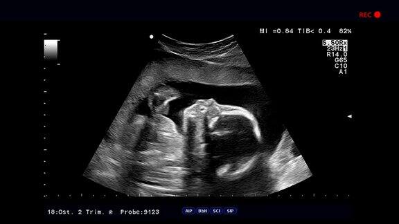 超声波检查胎儿在子宫里