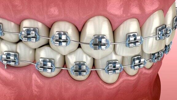 牙齿位置异常用金属支架矫正医学精确牙科3D动画
