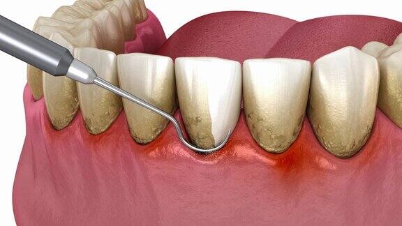 牙科洁牙(常规牙周治疗)医学精准3D动画