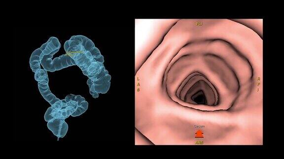 CT结肠镜三维绘制用于大肠癌筛查筛查结肠癌