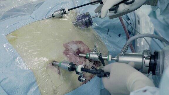 腹腔镜下的腹部手术