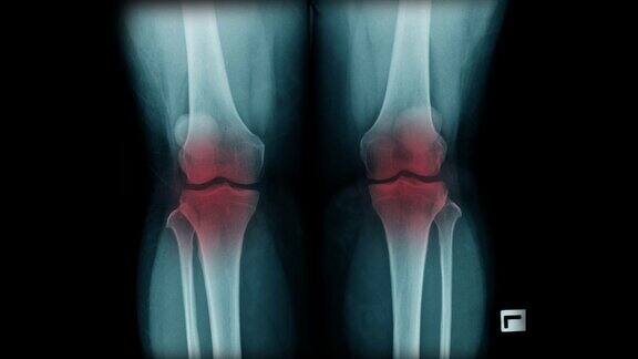 OA膝关节x线图像