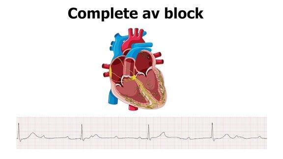 心电图显示心律失常、完全房室传导阻滞和心脏跳动