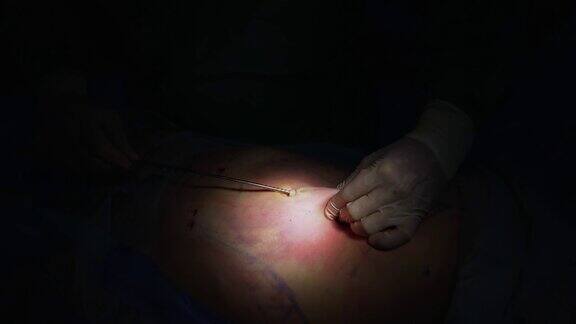 脂肪切除手术抽脂过程中医生的手放在病人腹部详细的手术过程特写镜头
