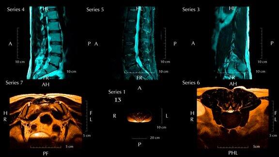 MRI腰椎或脊柱下段